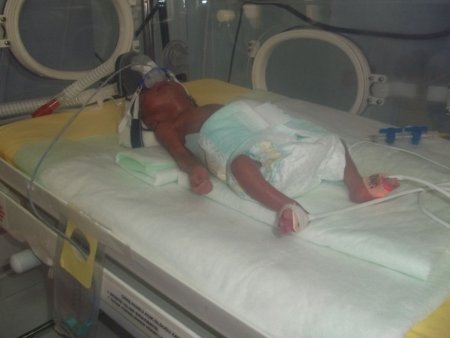 12 gün önce dünyaya gelen 560 gramlık parmak bebek hayata tutundu