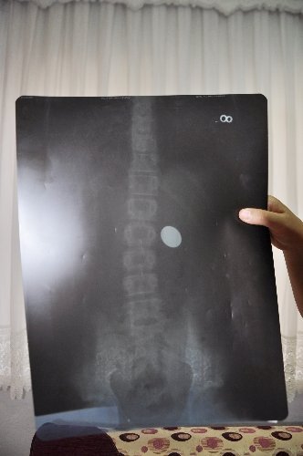 12 yaşındaki öğrenci 2 aydır midesindeki 1 lira ile yaşıyor