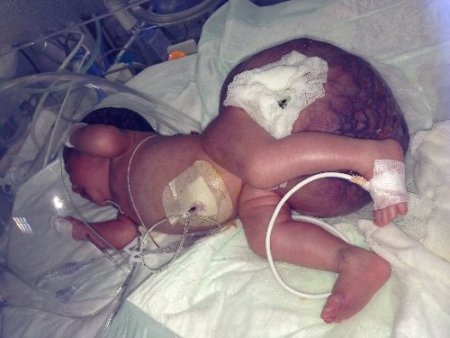 4 kilo doğan bebekten 2 kiloluk kitle alındı