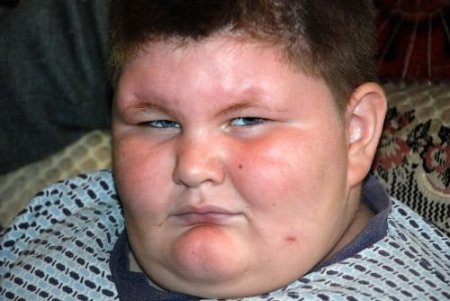 8 Yaşındaki Çocuk Bir Yılda 100 Kiloya Ulaştı