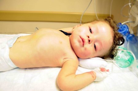 Alkolik Babanın Darp Ettiği Edanur Bebeğin Beyin Ameliyatı Olumlu Geçti