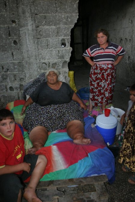 Aşırı kilolu ve sağlığı bozuk yaşlı kadına bakan hastane yok!