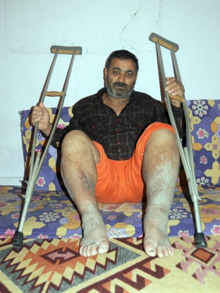 Askerde falakaya yatırılarak dövülen Özen, 28 yıldır yürüyemiyor (Özel)