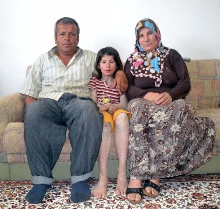 Balık derili kız, Sağlık Bakanı Mehmet Müezzinoğlu'ndan yardım istedi