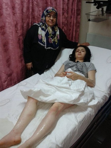 Barıştığı Eşini Kızgın Yağ Dökerek Yaktı