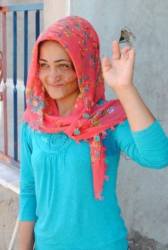 Bir yaşında yüzü yanan Sakine estetik ameliyat için yardım bekliyor