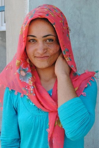 Bir yaşında yüzü yanan Sakine estetik ameliyat için yardım bekliyor