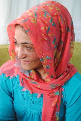 Bir yaşında yüzü yanan Sakine estetik ameliyat için yardım bekliyor