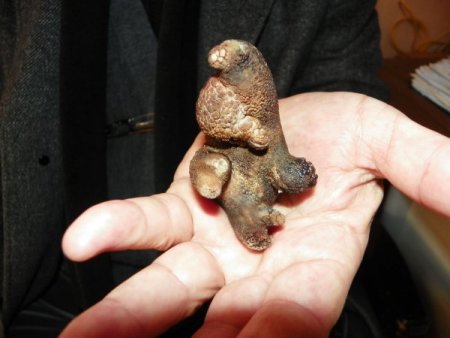 Böbreğinden at nalı tabir edilen taş çıktı