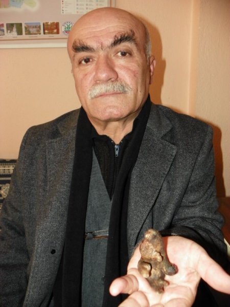 Böbreğinden at nalı tabir edilen taş çıktı