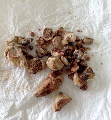 Böbreğinden bir avuç taş çıktı