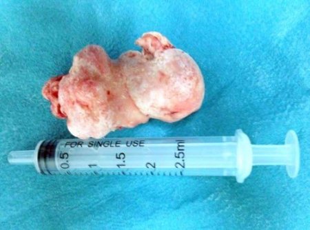 Burun kanalından ceviz büyüklüğünde tümör çıktı