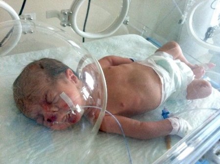 Doğduktan günler sonra burnundan nefes alabildi