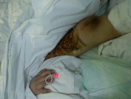 Doğum yapan hastanın elektrikli ocakla ısıtılması iddiası