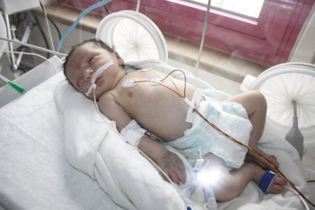 Doğumundan 10 dakika sonra ameliyatla kalp kapakçığı onarıldı