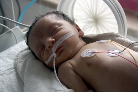 Doğumundan 10 dakika sonra ameliyatla kalp kapakçığı onarıldı