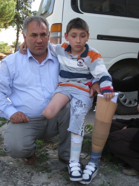 Doktorlar 'hastaneden koşarak çıkacak' dedi, ayağı kesildi