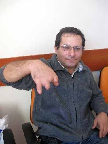 Dört Parmağını Kaybetti, Şimdi Engelli Olduğunu İspatlamaya Çalışıyor