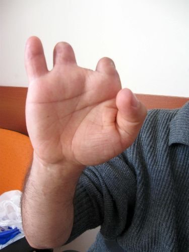 Dört Parmağını Kaybetti, Şimdi Engelli Olduğunu İspatlamaya Çalışıyor