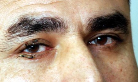 Elbistan'da görmeyen göz hamile bir bayandan alınan kordon zarıyla açıldı