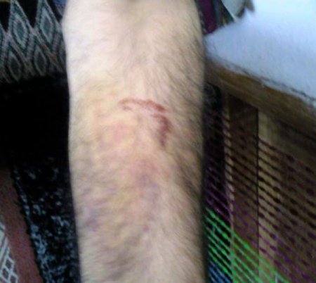 Eşeğin Isırdığı Adam Hastanelik Oldu