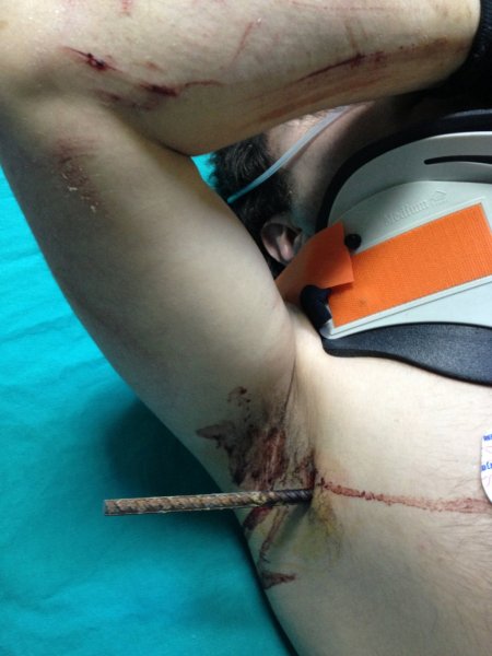 Göğsünü delip geçen demirle hastaneye kaldırıldı