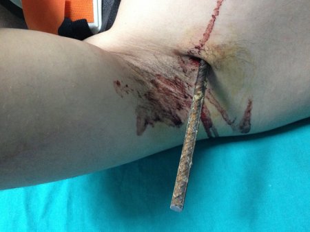 Göğsünü delip geçen demirle hastaneye kaldırıldı