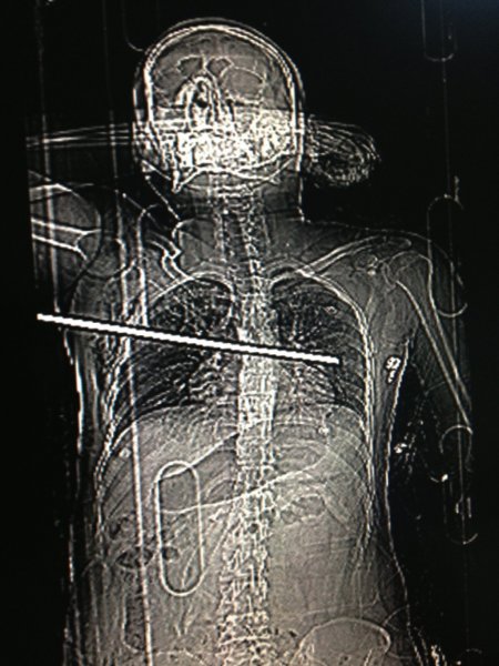 Göğsünü delip geçen demirle hastaneye kaldırıldı