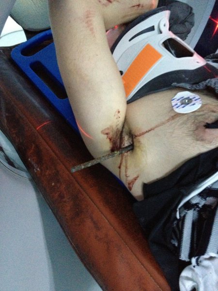 Göğsünü delip geçen demirle hastaneye kaldırıldı