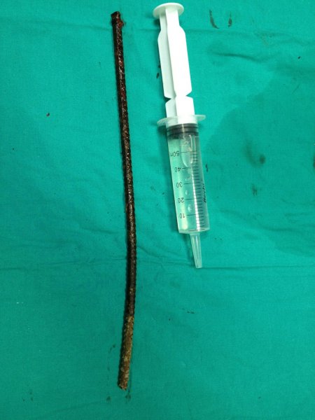 Göğsünü delip geçen demirle hastaneye kaldırıldı