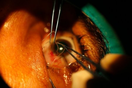 Gözünden 10 santimlik solucan (parazit) çıktı