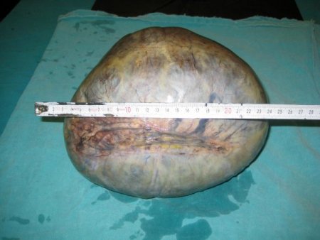 Hastanın Karnından 8 Kilo Ağırlığında Kist Çıkarıldı