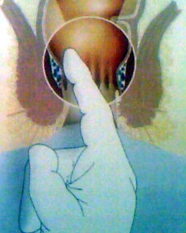 'Hemoroid’den korunmak için dar çamaşır giymeyin'