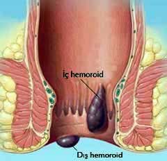 'Hemoroid’den korunmak için dar çamaşır giymeyin'