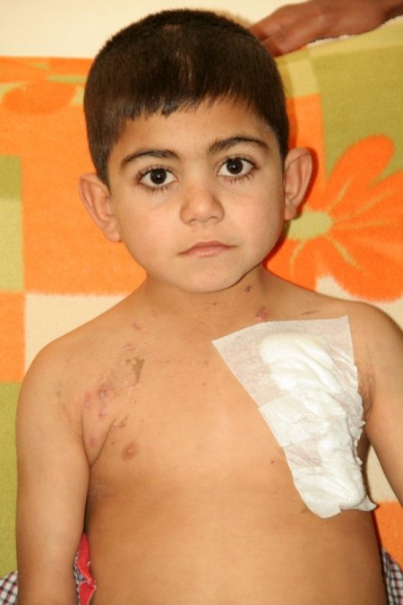 İki böbreği de olmayan minik Hazat nakil bekliyor