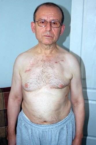 Kalp Pili Takıldı, 3 Yıldır Titriyor