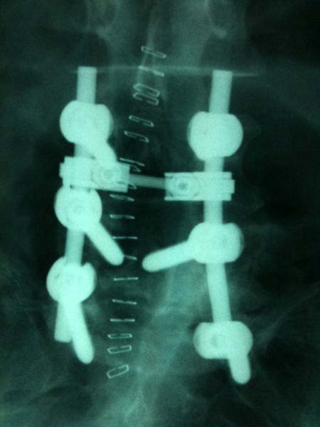 Karacabey’de ilk omurga ameliyatı