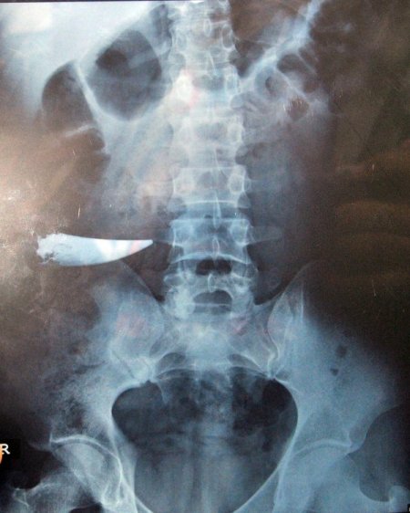 Karnında unutulan bıçakla 9 yıl yaşamış