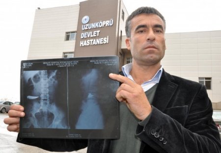 Karnında unutulan bıçakla 9 yıl yaşamış