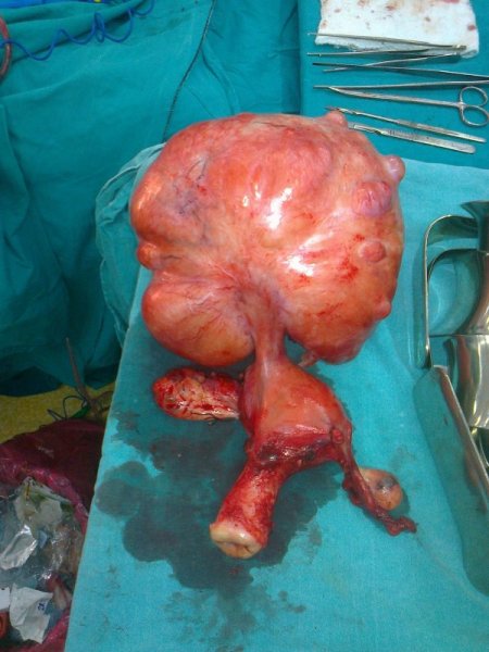 Karnından 3 kiloluk tümör çıkarıldı