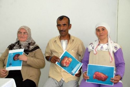 Kayseri'de 3 Hastanın Kalbinden 200'er Gram Tümör Çıkartıldı