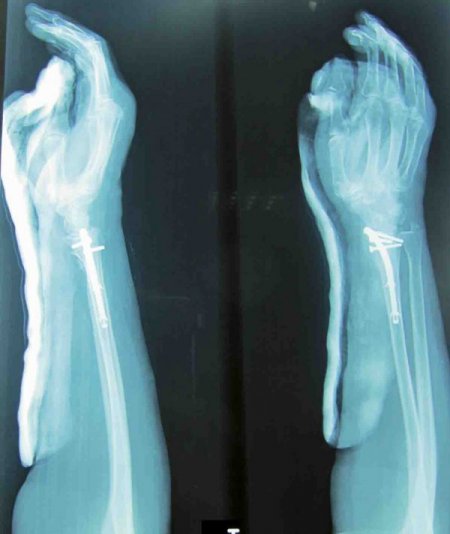 Kemik Erimesi, İlik İçi Çivi Yöntemi İle Korku Olmaktan Çıkıyor