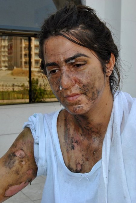 Kimyasal Madde İle Yakıldığı İddia Edilen Kadının İlk Duruşması Yapıldı