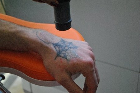 Kırıkkale Üniversitesi’nde lazer ile istenilmeyen izlere son veriliyor