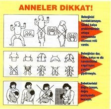 Kız çocuklarında kalça çıkıklığı, erkeklere göre 4 kat fazla