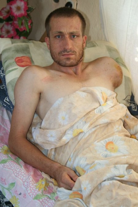 Kolunun İhmaller Nedeniyle Dikilemediğini Öne Süren Genç, Davaya Hazırlanıyor