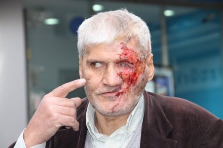 Maganda kurşunu ile hayatı karardı, yüz nakli için yardım bekliyor