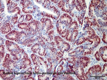 Manda yoğurdu, kalın bağırsak kanseri riskini yüzde 80 önlüyor