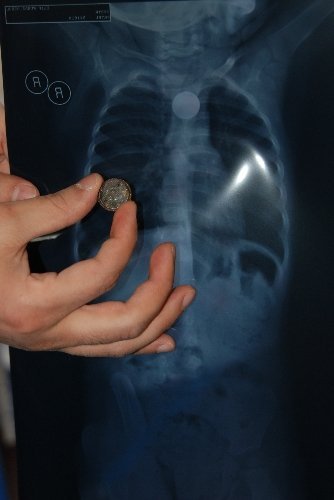 Minik Elif yutulabilecek en tehlikeli şeyi yuttu