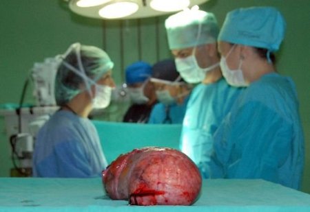 Nefes Darlığı Şikayetiyle Hastaneye Gitti, Karnından 6 Kg Tümör Çıktı